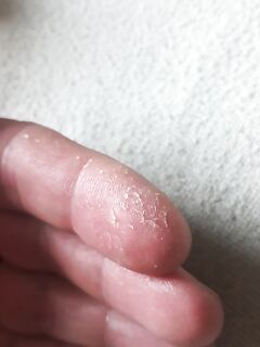 Крымская осторожность при ерше: укол анальным плавником у ногтя и как спасают кровь и лёд