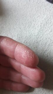 Рыбалка на Чёрном море: глубокий укол анальным плавником ерша при чистке